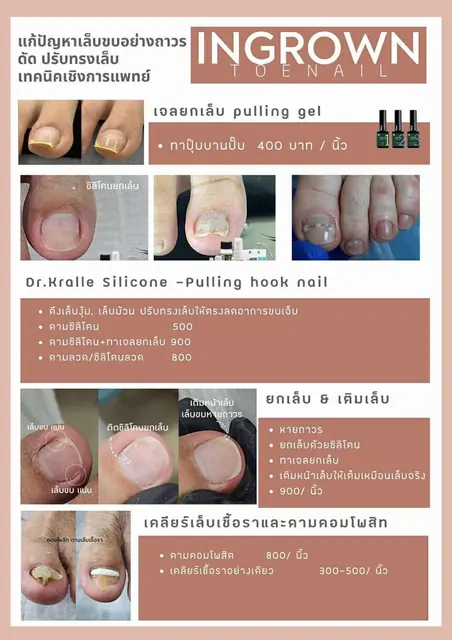 รักษาเล็บขบ เทคนิคเชิงการแพทย์