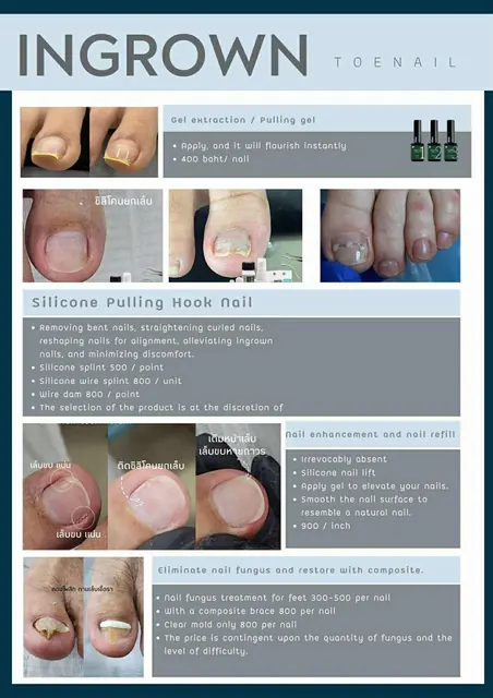 Ingrown toenail price list in English
